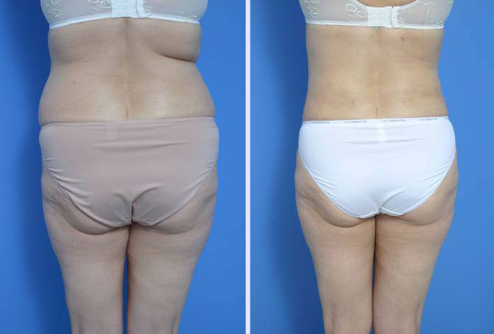 Before and After Image: liposuction – case 4 - back
