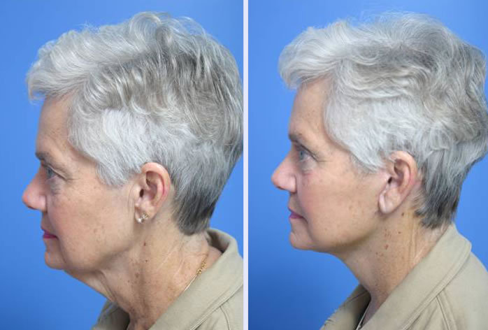 Before and After Image: facelift and mini facelift – case 3 - left-side