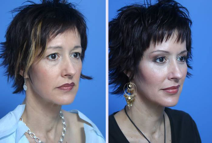 Before and After Image: facial fat grafting – case 3 - right-front-oblique