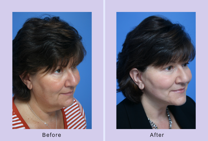 Before and After Image: buccal lipectomy – case 3 - right-front-oblique
