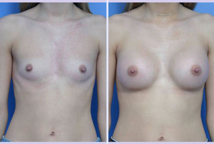 Before and After Image: breast augmentation – Case 19 - front