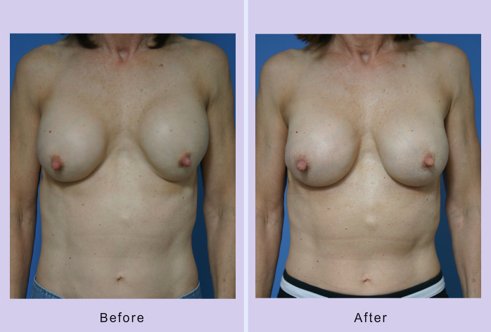 Before and After Image: breast correction – case 10 - front