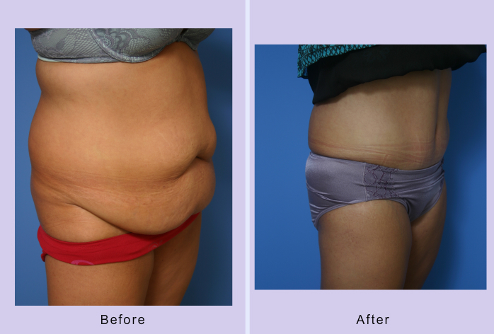 Before and After Image: abdominoplasty – tummy tuck – Case 16 - right-front-oblique