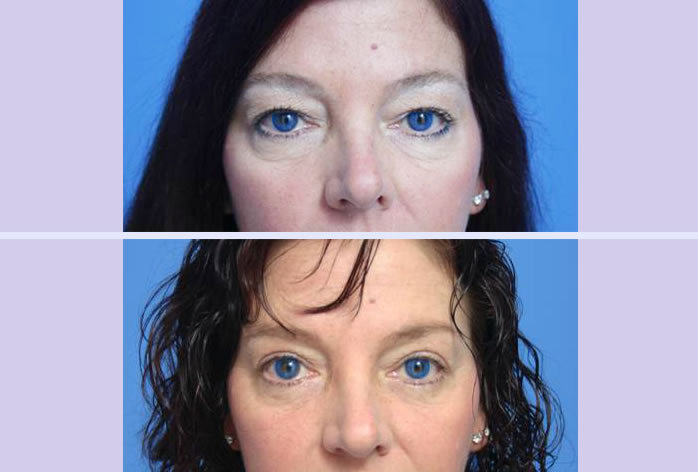 Before and After Image: blepharoplasty – case 6 - front