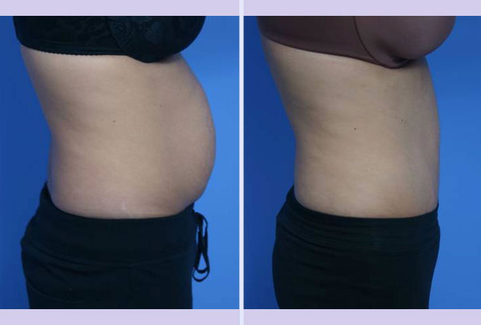Before and After Image: abdominoplasty – tummy tuck – Case 7 - right-side