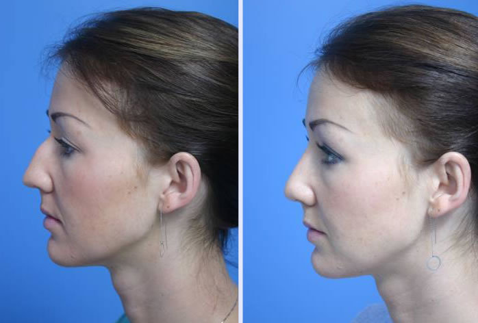 Before and After Image: rhinoplasty – case 2 - left-side