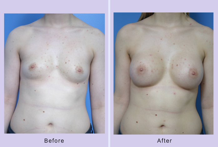 Before and After Image: breast augmentation – Case 20 - front