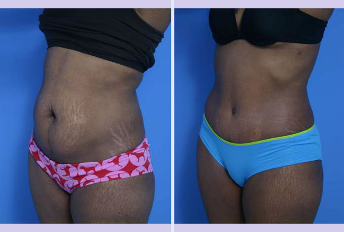 Before and After Image: abdominoplasty – tummy tuck – Case 2 - left-front-oblique