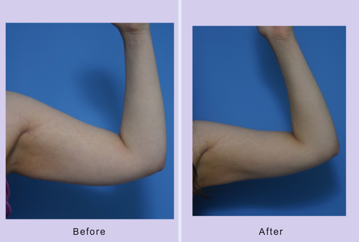 Before and After Image: liposuction – case 15 - left-side
