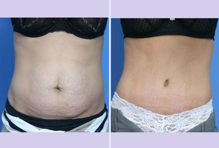 Before and After Image: abdominoplasty – tummy tuck – Case 9 - front