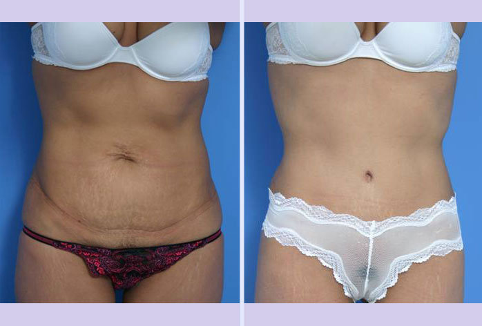 Before and After Image: abdominoplasty – tummy tuck – Case 4 - front