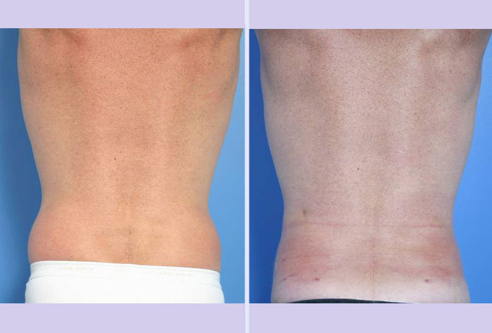 Before and After Image: liposuction – case 1 - back