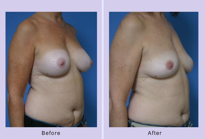 Before and After Image: breast implant removal – case 1 - right-front-oblique