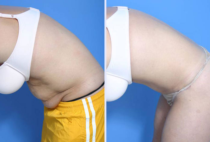 Before and After Image: abdominoplasty – tummy tuck – Case 5 - left-side