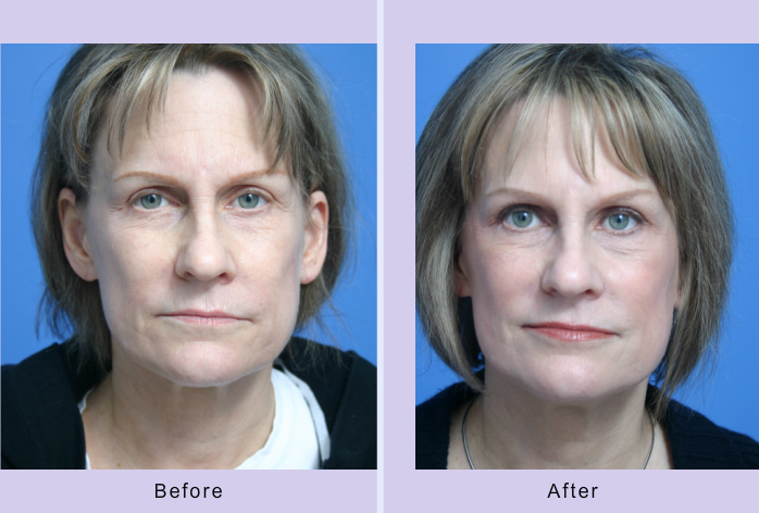 Before and After Image: blue peel - front