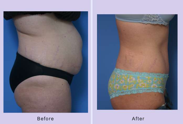 Before and After Image: abdominoplasty – tummy tuck – Case 15 - right-side