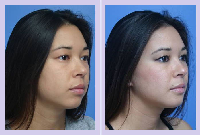 Before and After Image: chin augmentation – case 4 - right-front-oblique