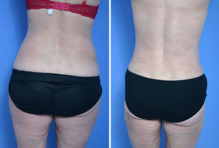 Before and After Image: liposuction – case 7 - back
