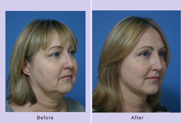 Before and After Image: facial reshaping – case 1 - right-front-oblique