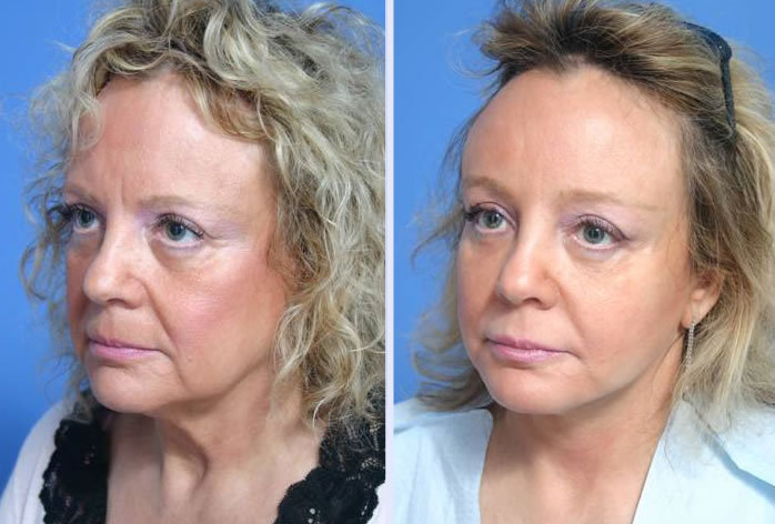 Before and After Image: 3-d volumetric facelift – case 8 - left-front-oblique