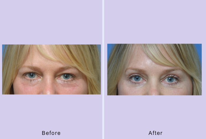 Before and After Image: blepharoplasty – case 11 - front