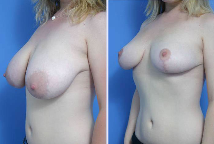 Before and After Image: breast reduction – case 3 - left-front-oblique