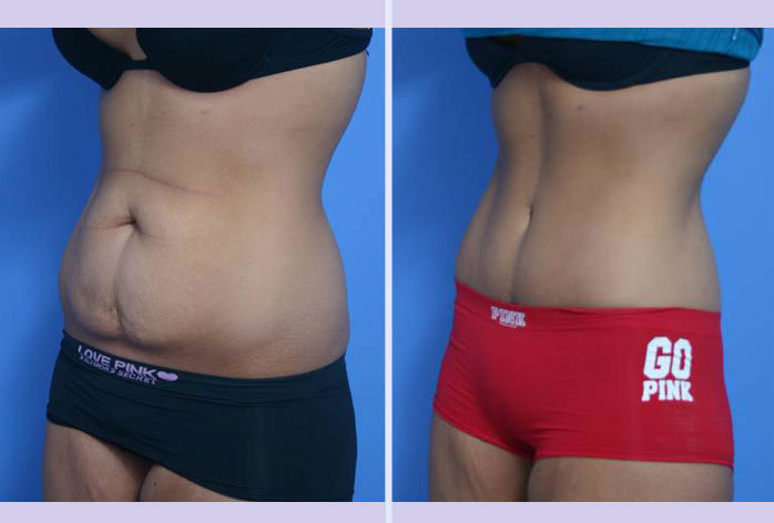 Before and After Image: abdominoplasty – tummy tuck – Case 9 - left-front-oblique