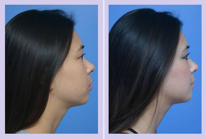 Before and After Image: chin augmentation – case 4 - left-side