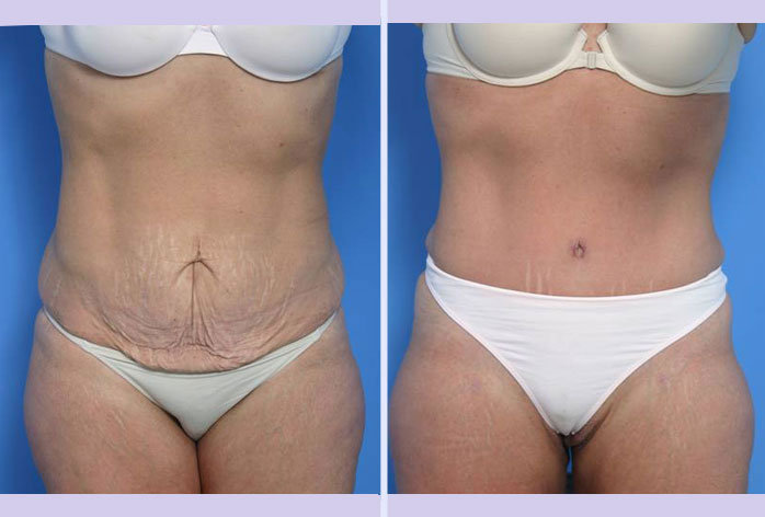 Before and After Image: abdominoplasty – tummy tuck – Case 6 - front
