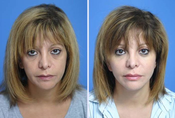 Before and After Image: 3-d volumetric facelift – case 3 - front