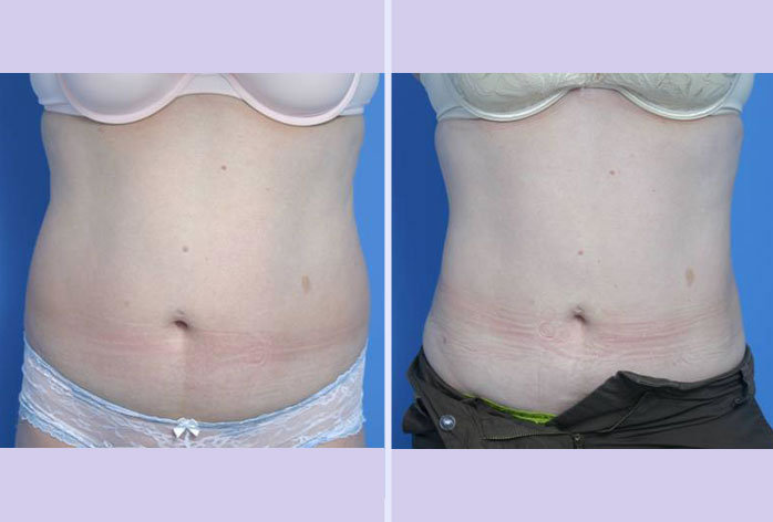 Before and After Image: liposuction – case 11 - front