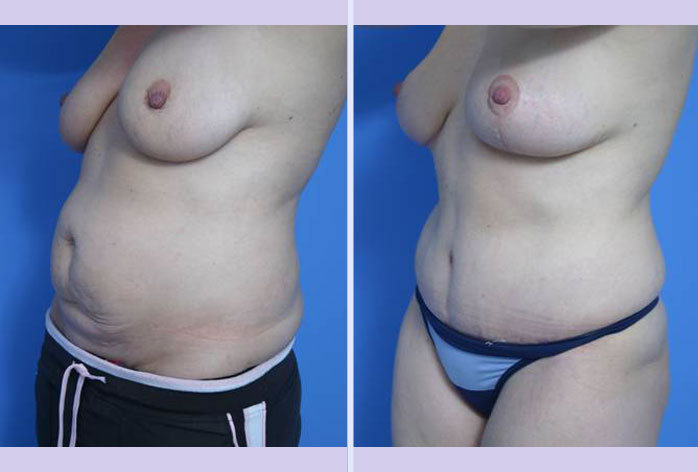 Before and After Image: abdominoplasty – tummy tuck – Case 23 - left-front-oblique