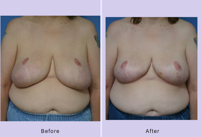 Before and After Image: breast reduction – case 6 - front