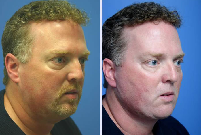 Before and After Image: 3-d volumetric facelift – case 7 - front