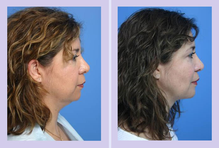 Before and After Image: bucccal lipectomy – case 1 - right-side