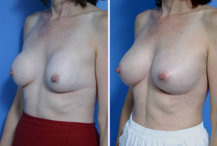 Before and After Image: breast correction – case 1 - left-front-oblique