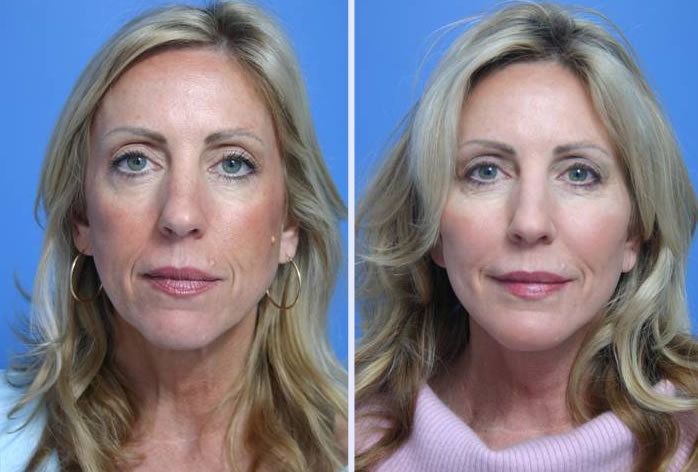 Before and After Image: 3-d volumetric facelift – case 1 - front