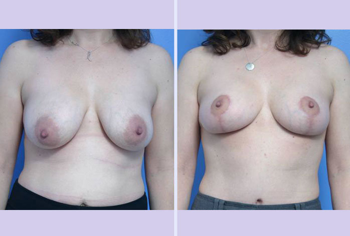Before and After Image: breast lift – case 6 - front
