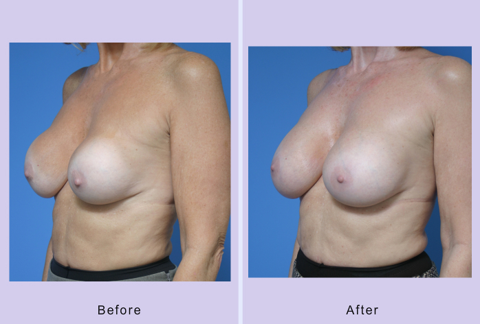 Before and After Image: breast correction – case 6 - left-front-oblique