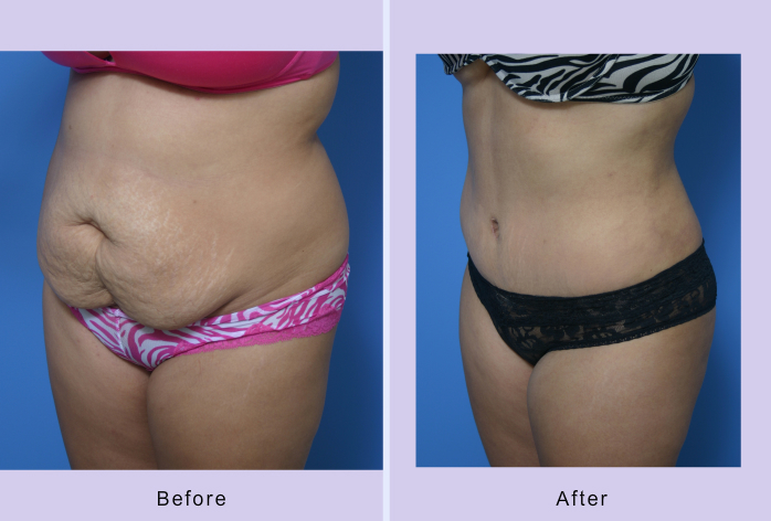 Before and After Image: abdominoplasty – tummy tuck – Case 14 - left-front-oblique
