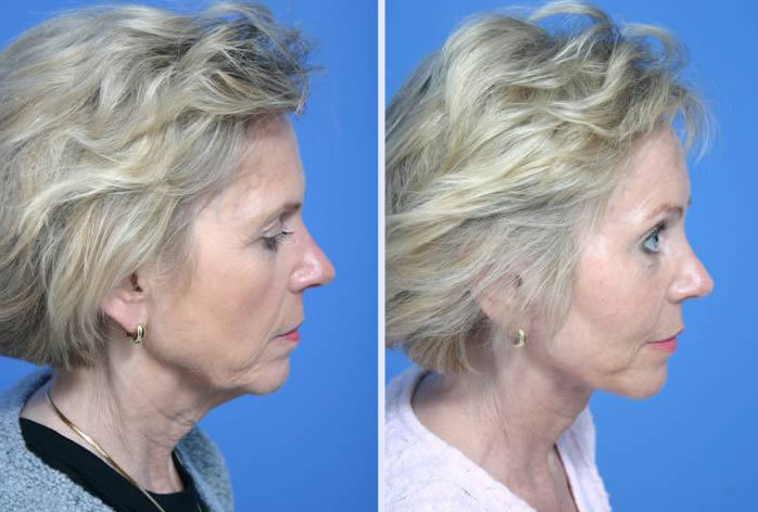 Before and After Image: 3-d volumetric facelift – case 6 - right-side