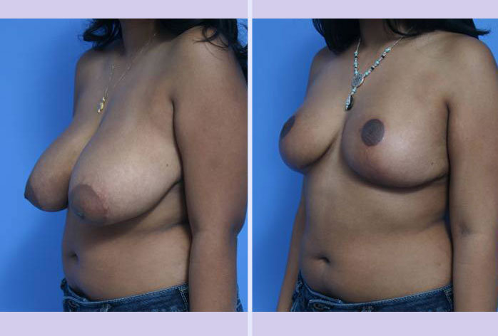 Before and After Image: breast reduction – case 4 - left-front-oblique