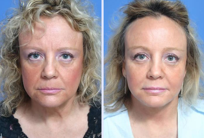 Before and After Image: 3-d volumetric facelift – case 8 - front