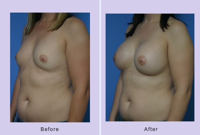 Before and After Image: breast augmentation – Case 27 - left-front-oblique