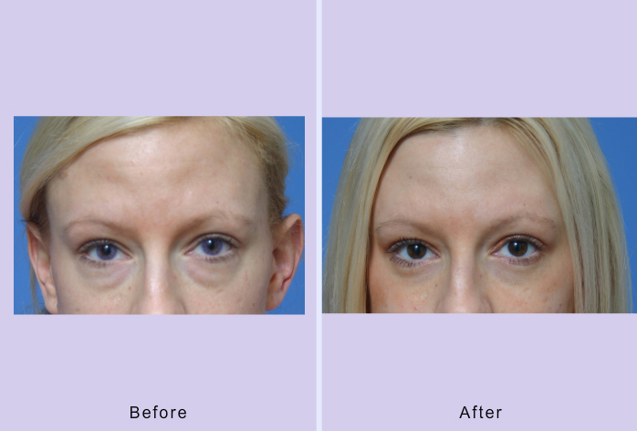 Before and After Image: blepharoplasty – case 10 - front