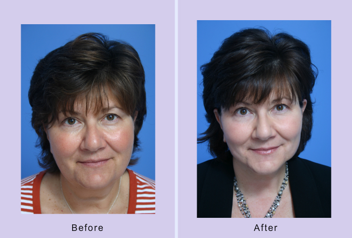 Before and After Image: buccal lipectomy – case 3 - front