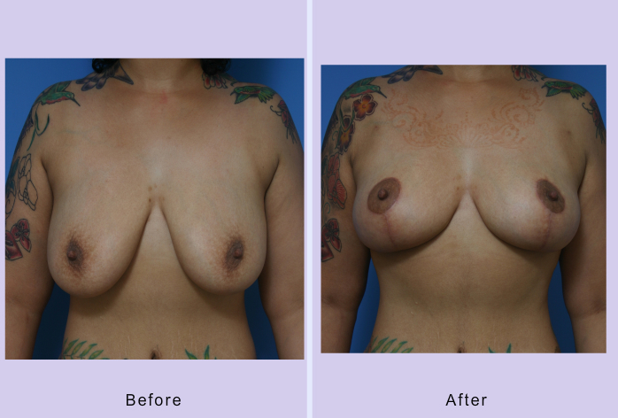Before and After Image: breast lift – case 7 - front