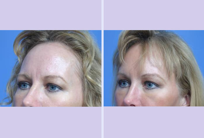 Before and After Image: browlift – case 2 - left-front-oblique