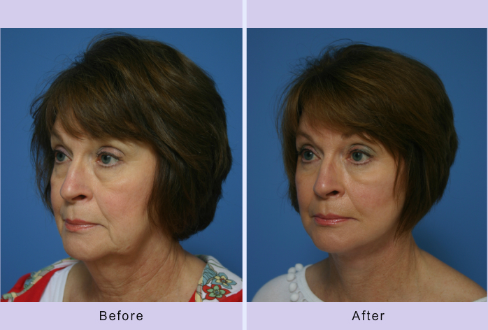 Before and After Image: facelift and mini facelift – case 5 - left-front-oblique