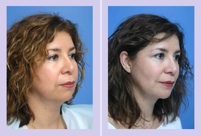 Before and After Image: facial reshaping – case 2 - other